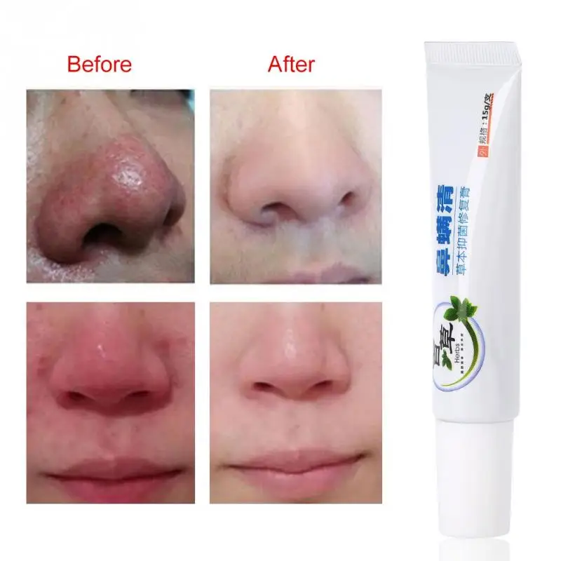 

Крем Rosacea Антибактериальный для удаления красных точек на носу