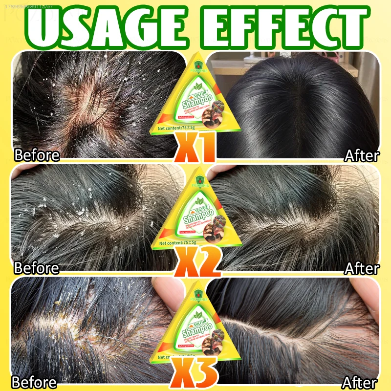 แชมพูบาร์สูตรพฤกษศาสตร์สำหรับผ - Hair Care Dandruff บทวิจารณ์และราคา