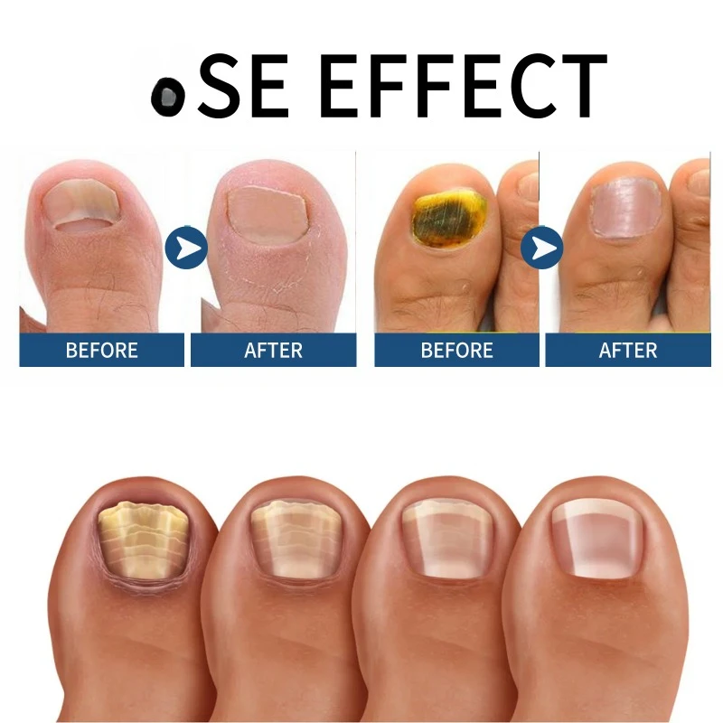 Toenail Fungus repair essence Treatment onychomycosis hand feet fungal Anti-infective Paronychia soft nails thickening nail Gel