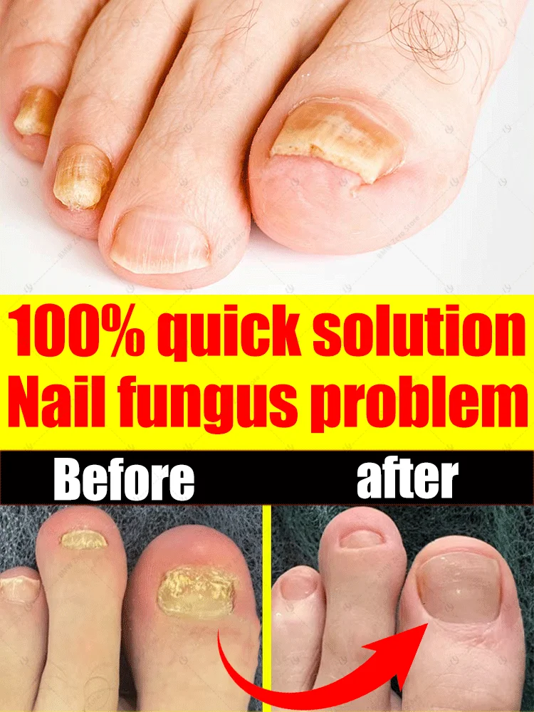 Beat Discolored Nails: Mild Plant Care for Bright Lovely Nails