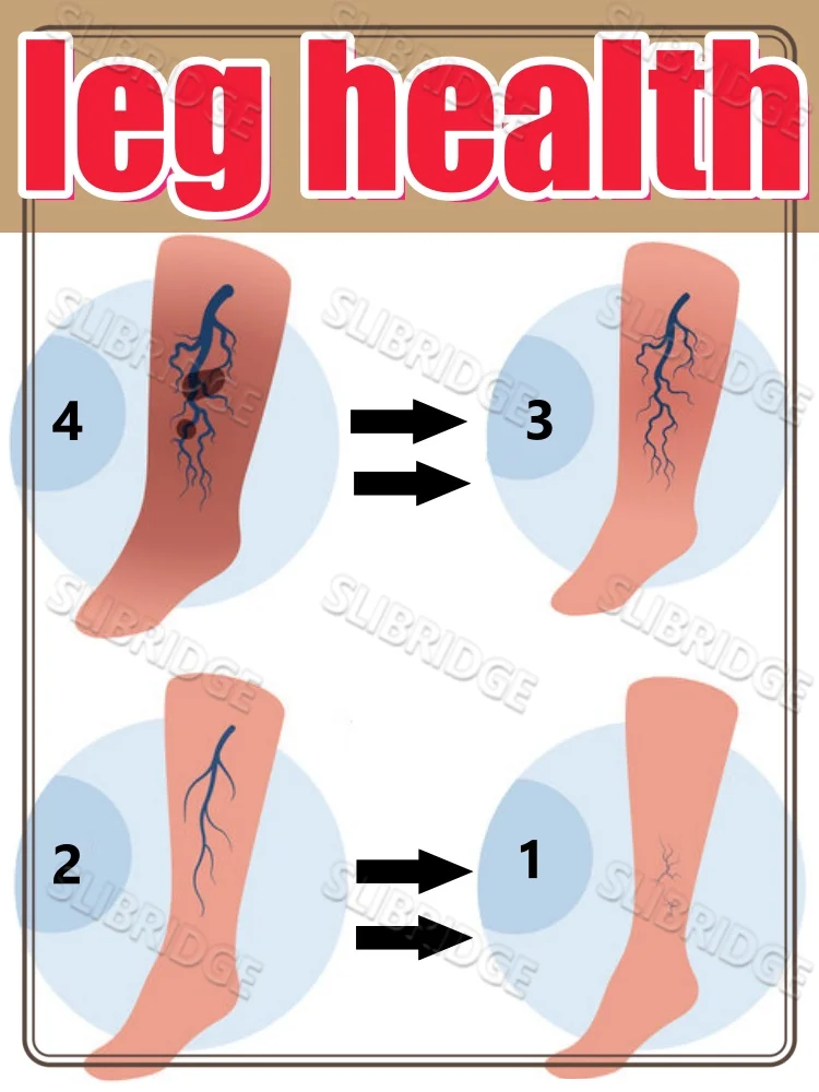 الاستخدام الليلي فقط، يحسن الدورة الدموية الدموية للساق، أداة العناية بصحة الساق