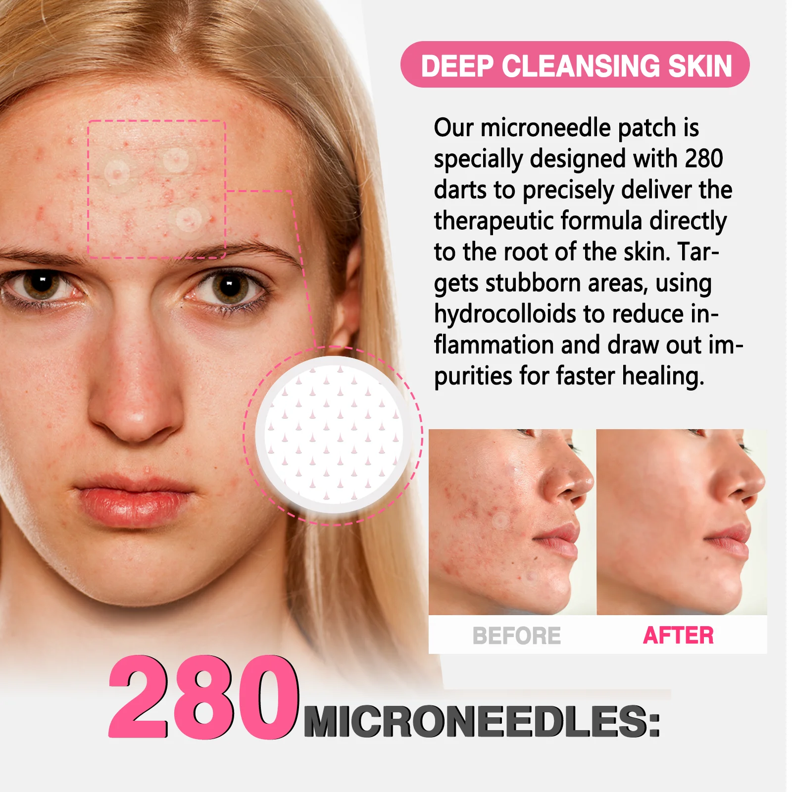 18 ชิ้น 280 เข็มขนาดเล็กสำหรับรักษาสิว ลดรอยแผลเป็นและอ่อนโยนต่อผิว แผ่นแปะสิว ลดการอักเสบ ผลลัพธ์เร็ว