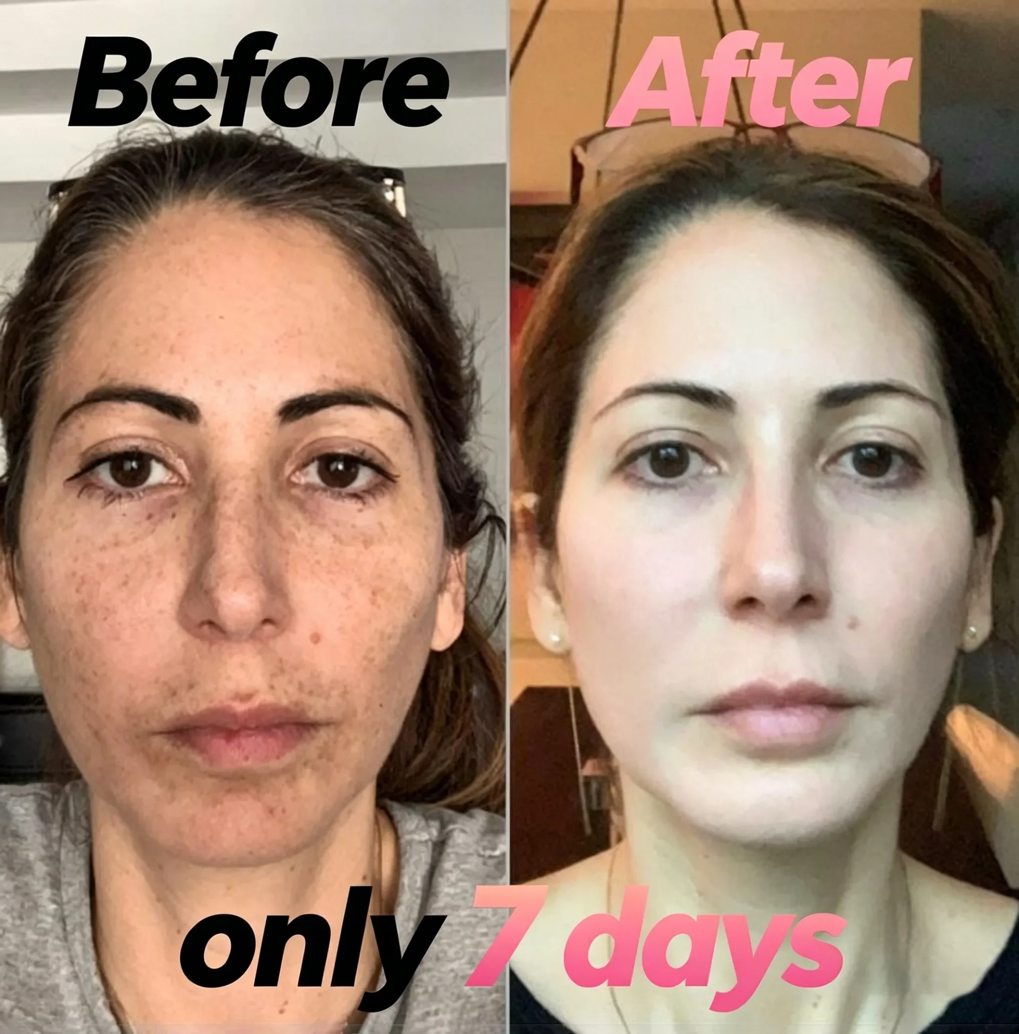 

Removes blemishes, brightens skin tone, and eliminates melanin deposits, age spots, and dark spots. Age spot removal tool.