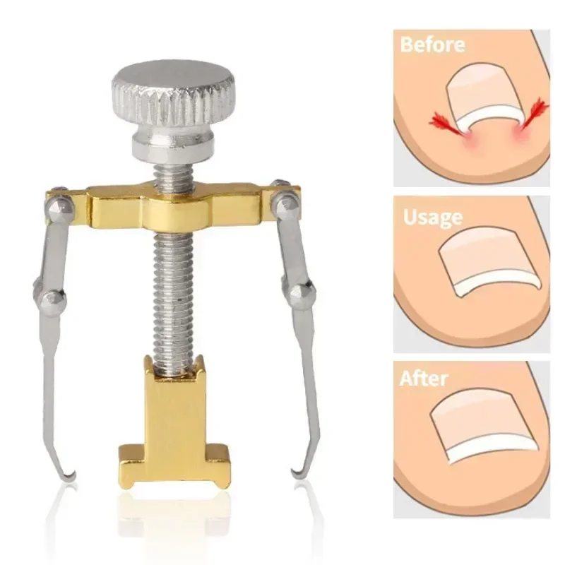 Ingrown Toenail Corrector Straightening Clip Pedicure Foot Nail Care Tools Stainless Steel Pedicure Treatment Onyxis Correction