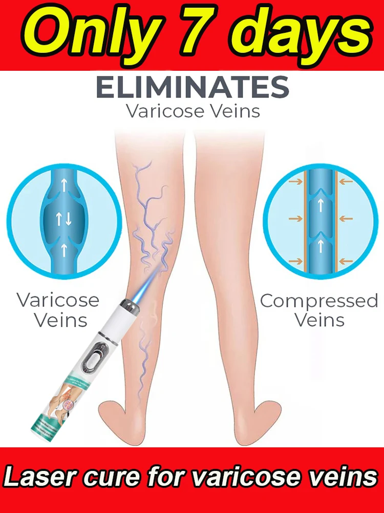

Effective treatment for varicose veins, relieves dilated vasculitis of leg phlebitis, avoids surgical pain