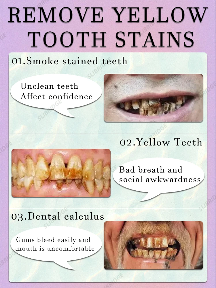 Decay tooth cavities healing anti caries