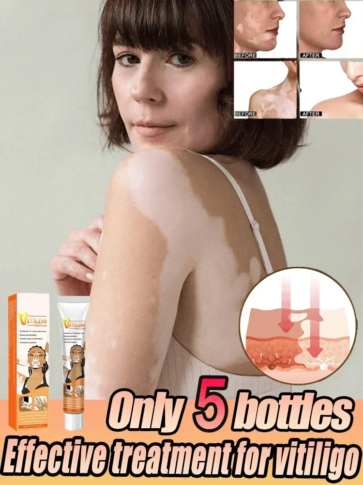 

Vitiligo Cream - Vitiligo Skin Care | Natural Skin Repigmentation Therapy