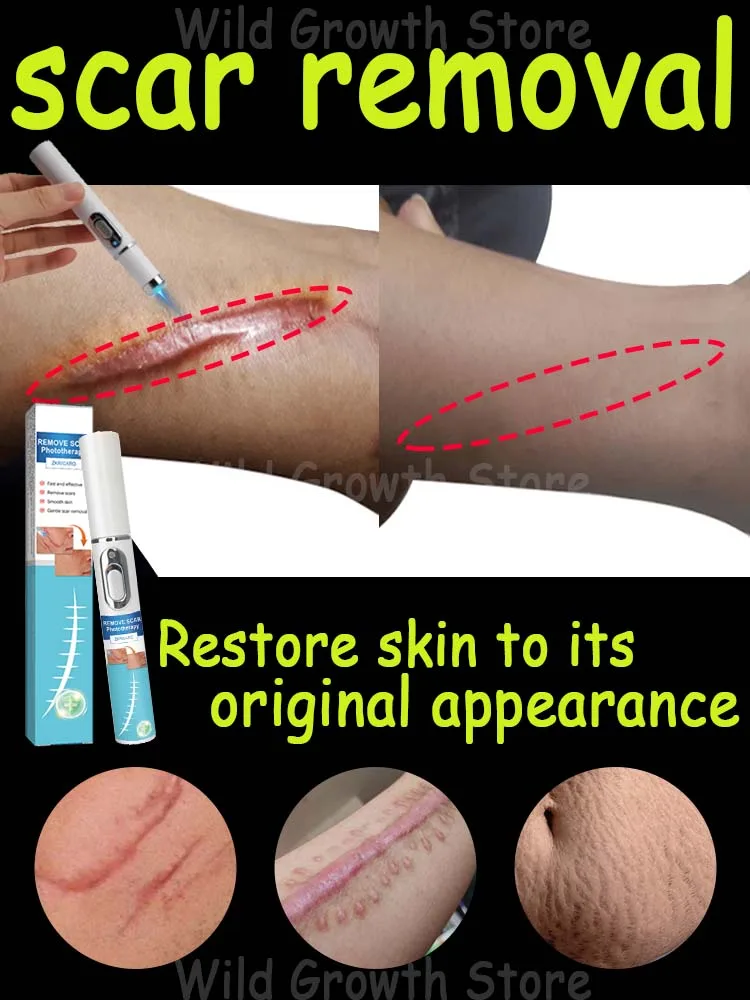 

Laser repair of skin scars hot sale