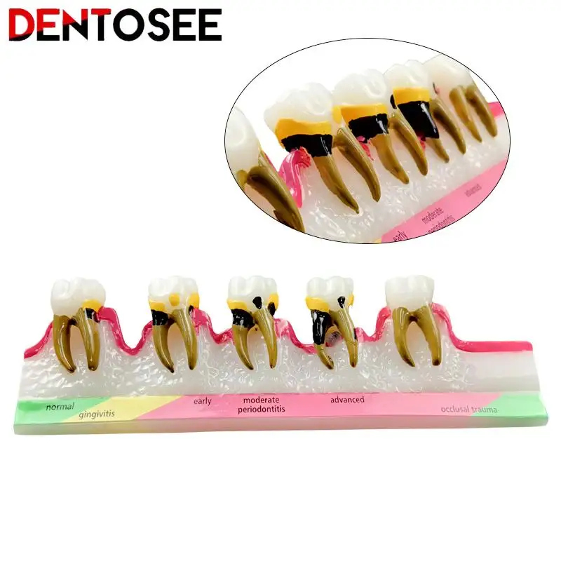 Periodontal Disease Classification Demonstration Model 5 Stages Teaching Tools for Medical Students