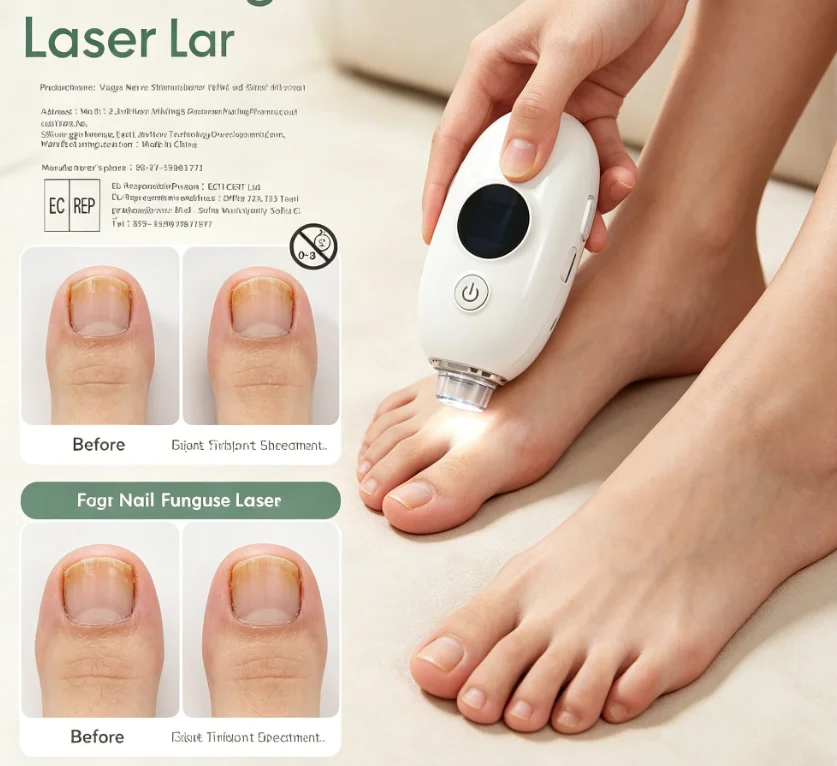 

Cleaning Laser Remove Cure Ingrown Tool Repair Fast Nail Fungus Onychomycosis Fungus Laser Device