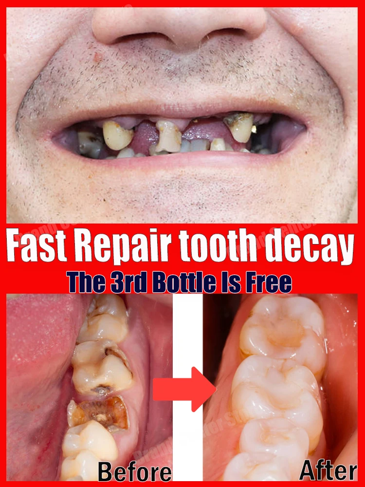 Decay tooth cavities healing anti caries