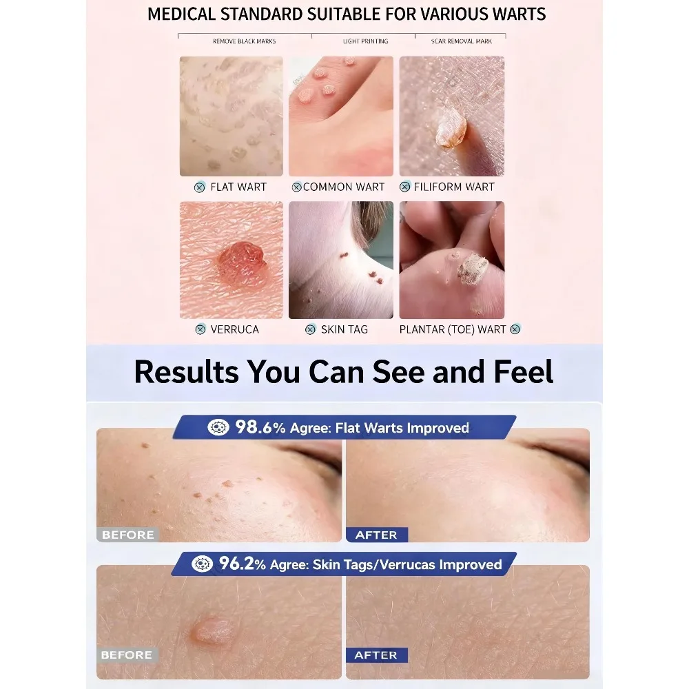 2025 Wart Removal Pen - Safe and Effective, Warts Fall Off Automatically