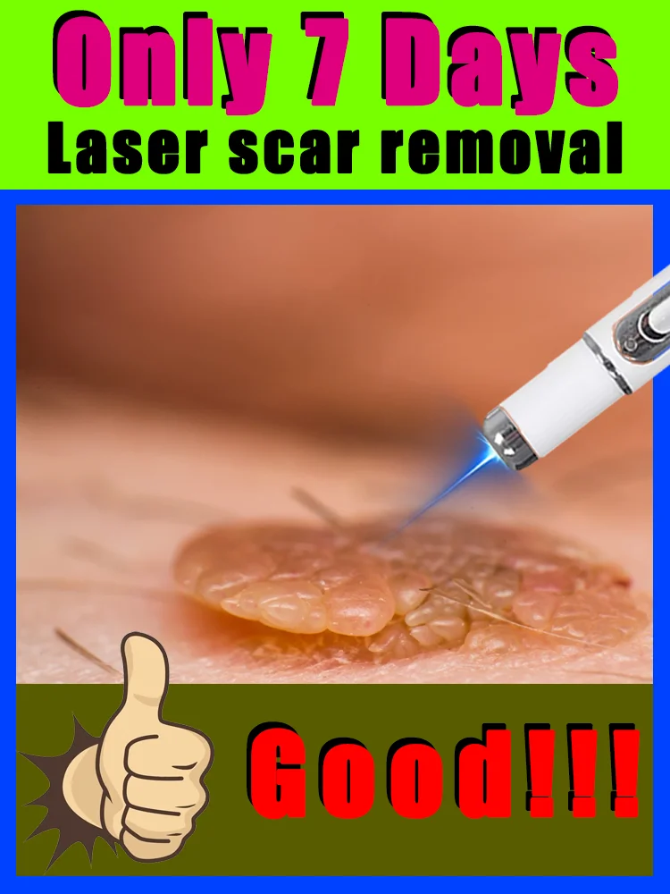 blue light pen solve warts,Worry-free wart removal,free shipping,wart care tools