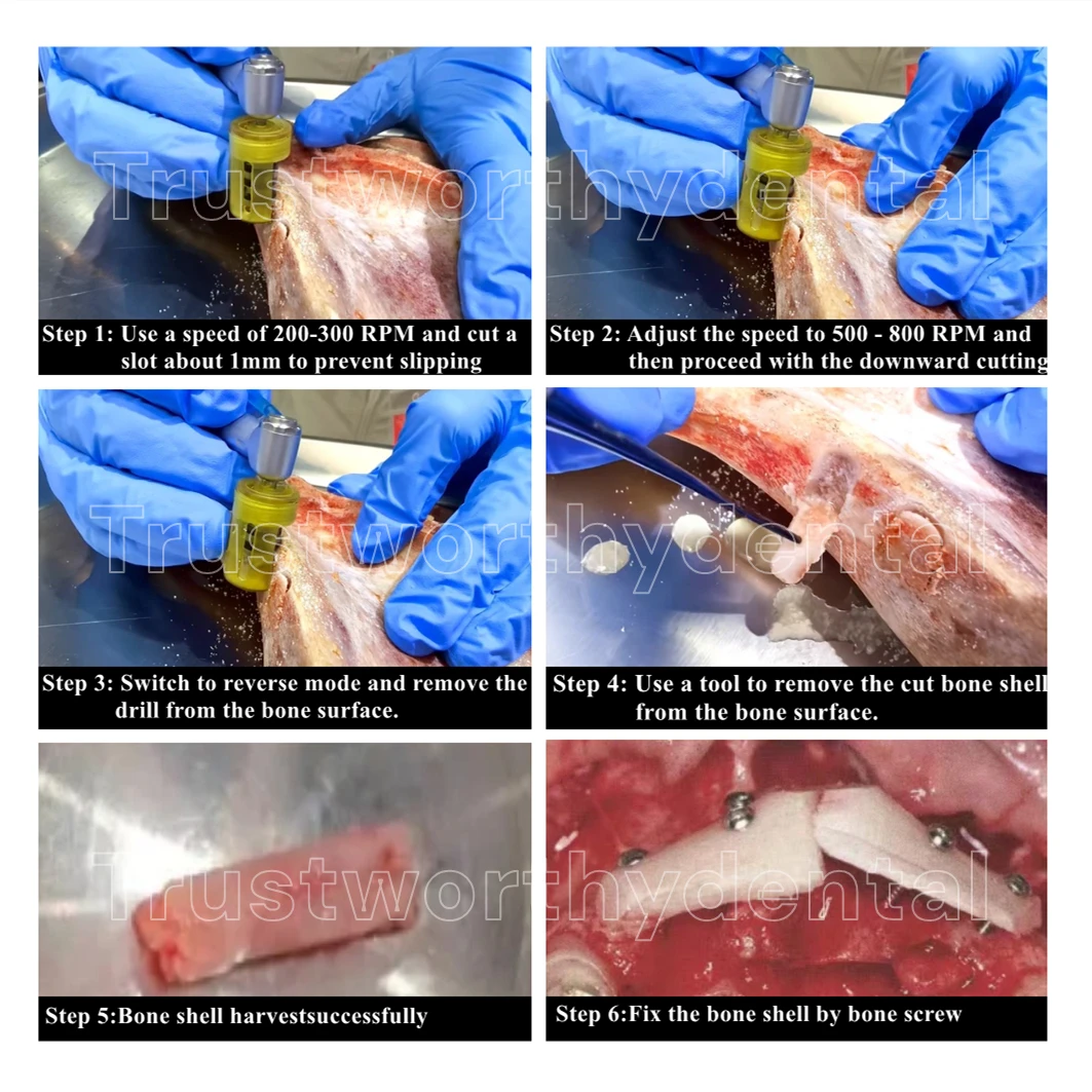 Dental SLT Easy Bone Collector Semilunar Technique GBR SLT Drill Implant Semilunar Shell Bone Argumentation Harvest EBC HalfMOON