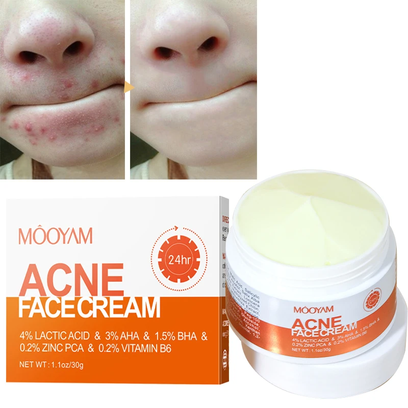 Herbal Acne Removal Face Cream Anti-Acne Gel Treatment Acne Scar Pore Shrinking Eliminate Large Pores Pimples Whitening Care