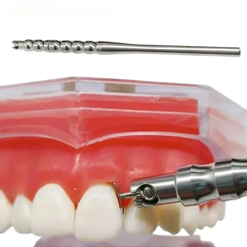 Dental Implant Gingival Protector Socket Shield Retractor for Gum Separation and Isolation with 3 Replaceable Tips