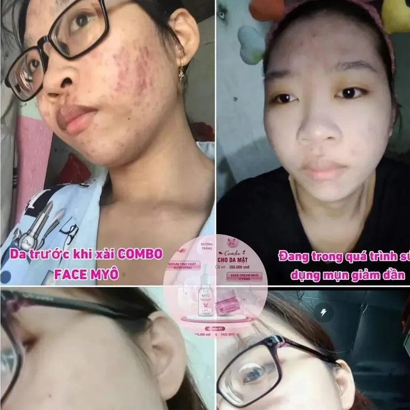 SET KÍCH TR NangNG VITAMIN X10 MYÍCH, ÍCH SAVE KOLAGEEN, Traniya da M ien, kich Trang Combo Duong Da Kem Face Myo Mattkörper