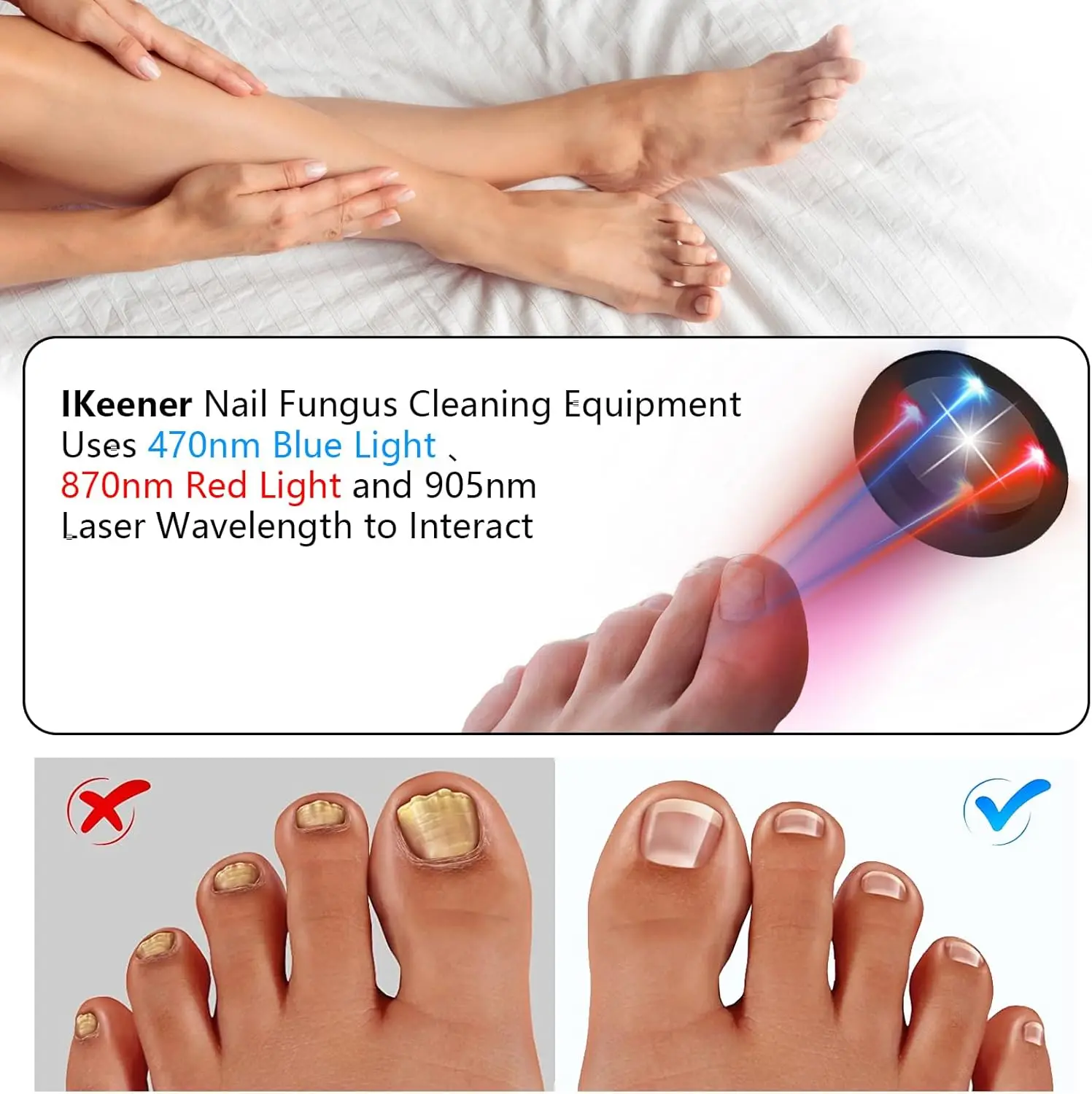 Nail Fungus Laser Device 470nm Blue Light&660nm Red Light&905nm Super Pulsed Invisible Light Smart Remove&Repair Fungal Nail