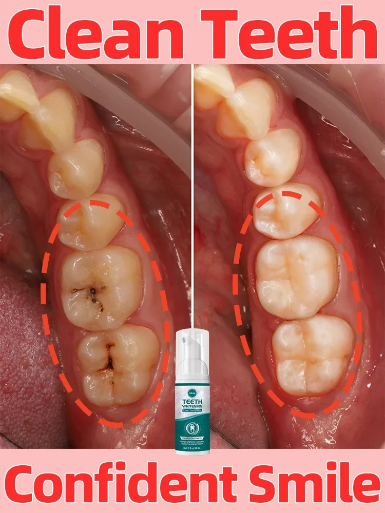 Limpieza de dientes tiene un efecto blanqueador, que es eficaz para manchas profundas, producto para el cuidado del blanqueamiento dental, regalos saludables