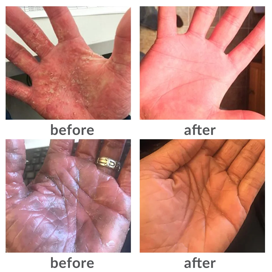 ZJZK-Vitiligo et psoriasis à LED, 308nm, traitement de la peau, maladie de la peau, formateur ultraviolet de qualité médicale pour eczégyptiet dermatite