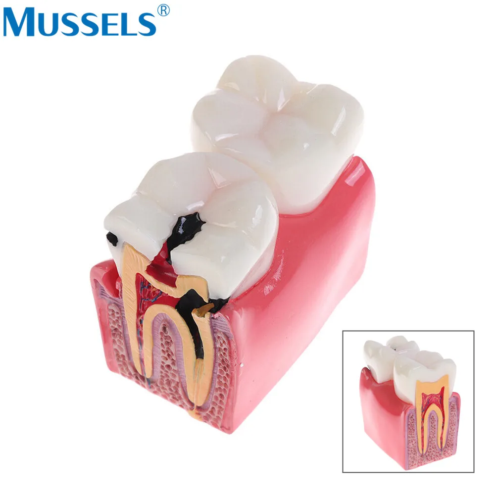 4 Times Implant Teeth Model Dental 6 Times Caries Comparation Study Models Removable Crown Bridge Teaching Demonstration Lab