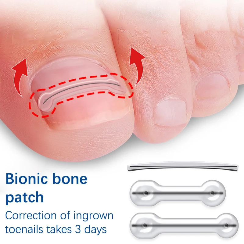 Ingrown Toenail Correction Tool Orthopedic Supplies Elastic Patch Sticker Straightening Clip Brace Pedicure Tool 1Pcs