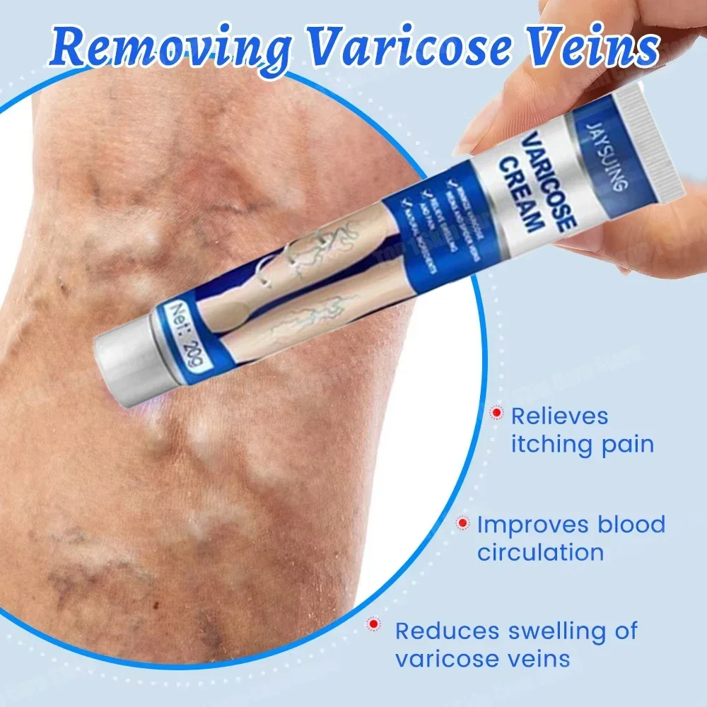 

Varicose Vein Treatment Cream 20g Painless Removal Spider Vein Pain Varicosity Effective Varicose Healing Cream