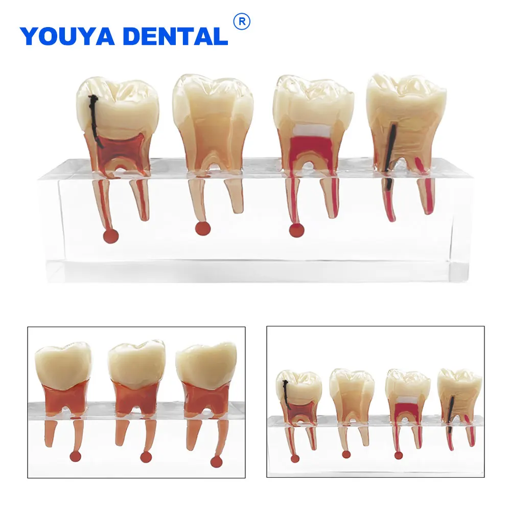 

Dental Transparent Endodontic Caries Pathological Teeth Model For Studyting Teaching For Treatment Demonstration Patient Model