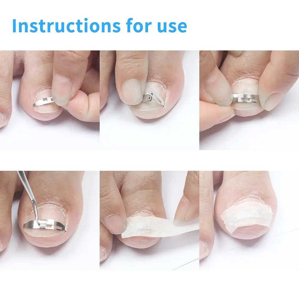 Effective Foot Health Care Paronychia Ingrown Toenail Straightener Pedicure Tools Correction