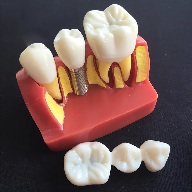 4 Times Dental Implant Teeth Model Analysis Crown Bridge Demonstration Removable Dentist Teaching Training Student Study Model