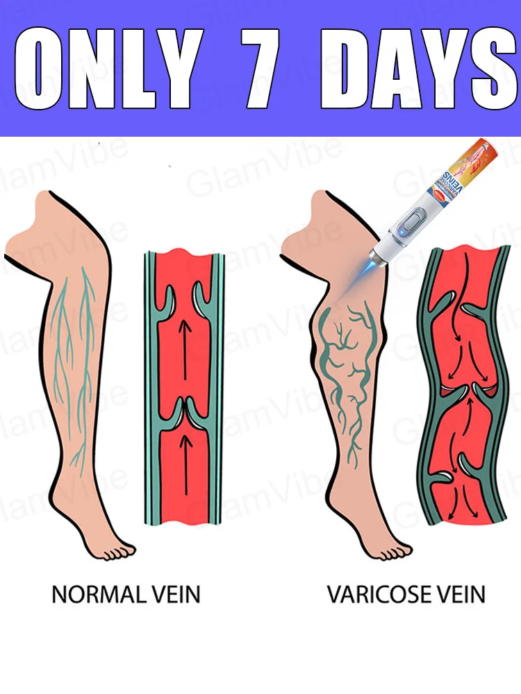 

blue light pen solve varicose veins, hot sale leg care tools