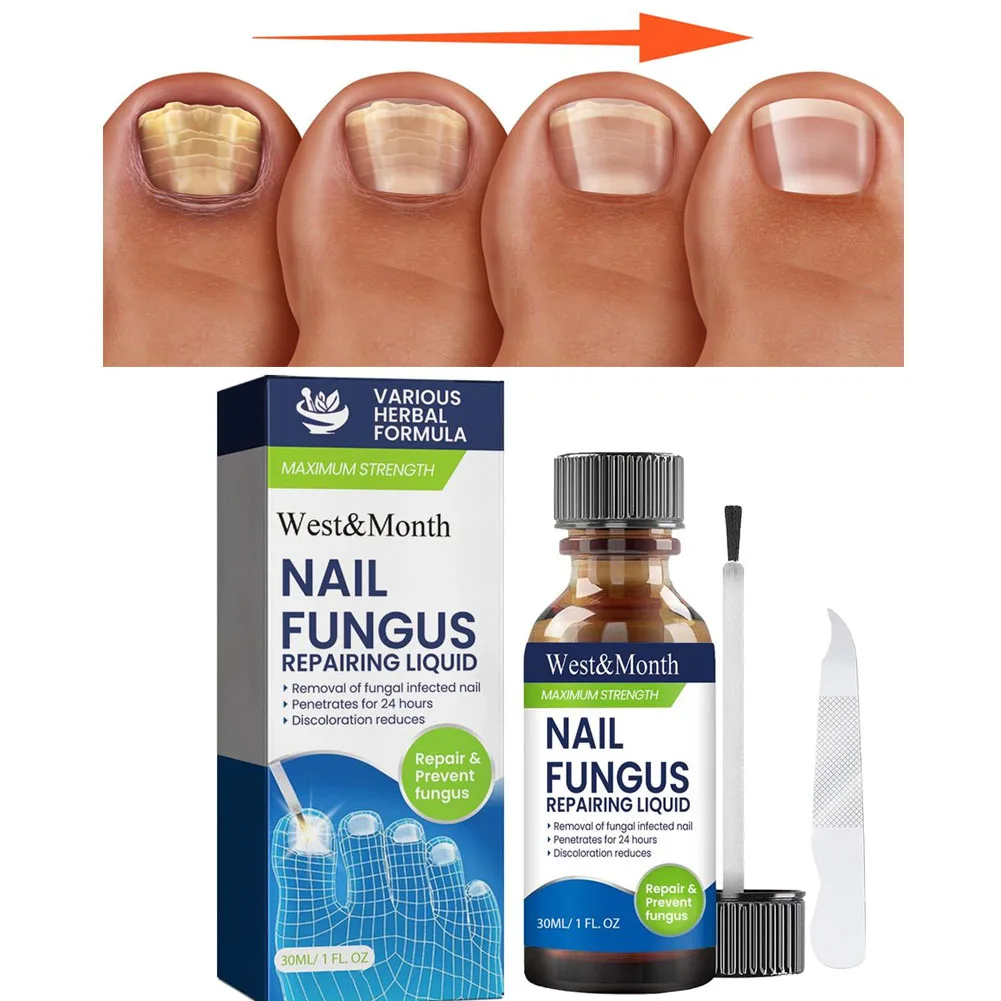 Nail Fungus Care Solution Anti-Infection Onychomycosis Repair Damaged Cracked Hand Foot Nail Manicureed Health Care Essence