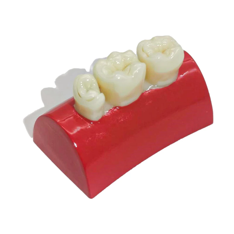 1Pc Dentale Intarsio Modello di Esercizio Blocco di Riempimento Esercizio Typodont Resina Modello di Riempimento Orale Modello di Pratica Odontoiatria Insegnamento Studio