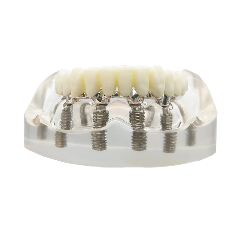 Zahnimplantatmodell, transparenter oberer unterer Kiefer, 6 Implantate, Overkappungszähne, Wiederherstellungszähne mit 6 abnehmbaren Schrauben, Dental Demo – Detail 5