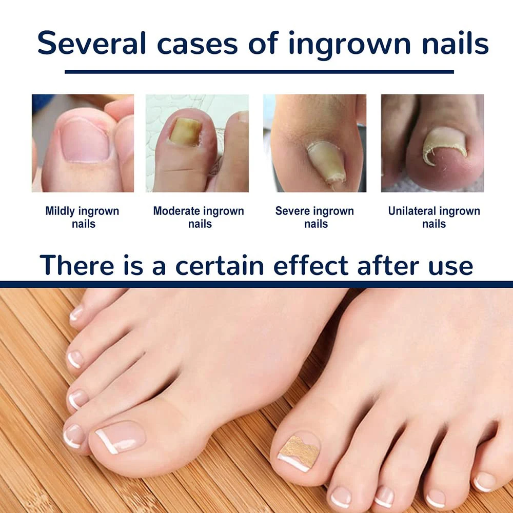 50/100pcs Ingrown Toenail Corrector Patches Nail Correction Care Stickers Paronychia Treatment Recover Corrector Pedicure Tool