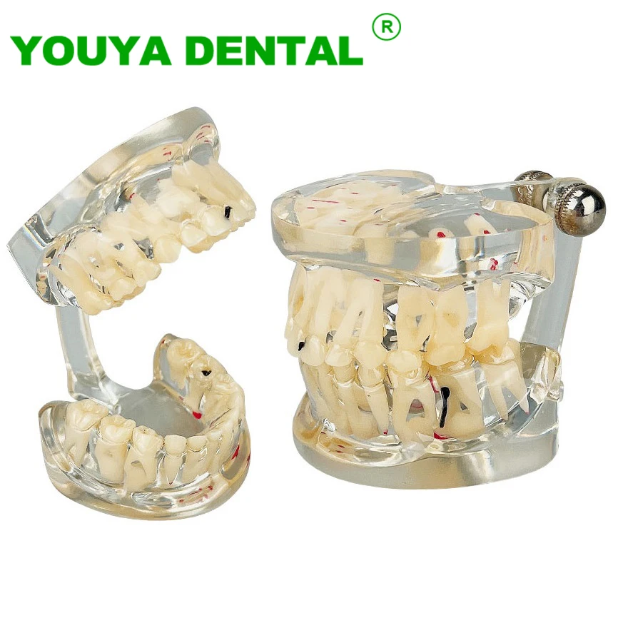 Child Dental Model Primary And Permanent Teeth Alternating Model With Pathology Caries Dentist Student Study Teaching Tools