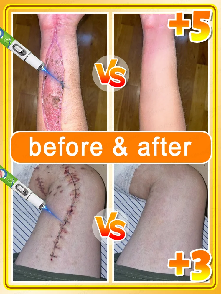 Qᴜɪᴄᴋʟʏ ʀᴇᴘᴀɪʀ sᴄᴀʀs, ʀᴇᴍᴏᴠᴇ ᴘɪɢᴍᴇɴᴛᴀᴛɪᴏɴ, ᴘᴏʀᴛᴀʙʟᴇ sᴄᴀʀ ʀᴇᴍᴏᴠᴀʟ ʟᴀsᴇʀ ᴘᴇɴ, ʀᴇᴘᴀɪʀ sᴄᴀʀs ᴀᴛ ᴀɴʏ ᴛɪᴍᴇ