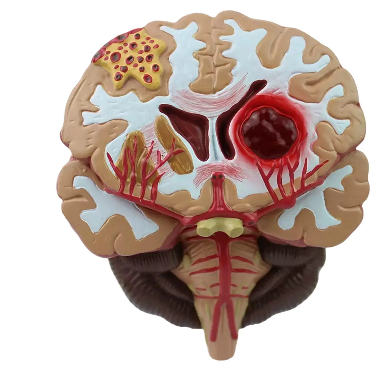 PVC Human Brain Arteriovenous Malformations Stroke Model Medical Teaching Models