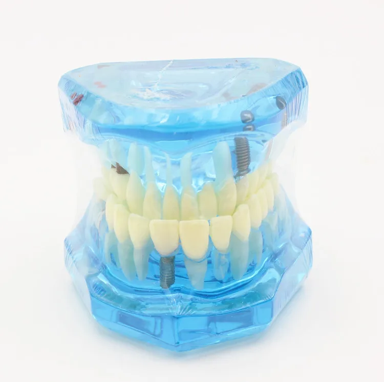 Dentalmodelle reparierbare Harzmodelle für erkrankten Zähne für den Unterricht und Forschung in Medizin und Zahnkrankungen – Detail 8
