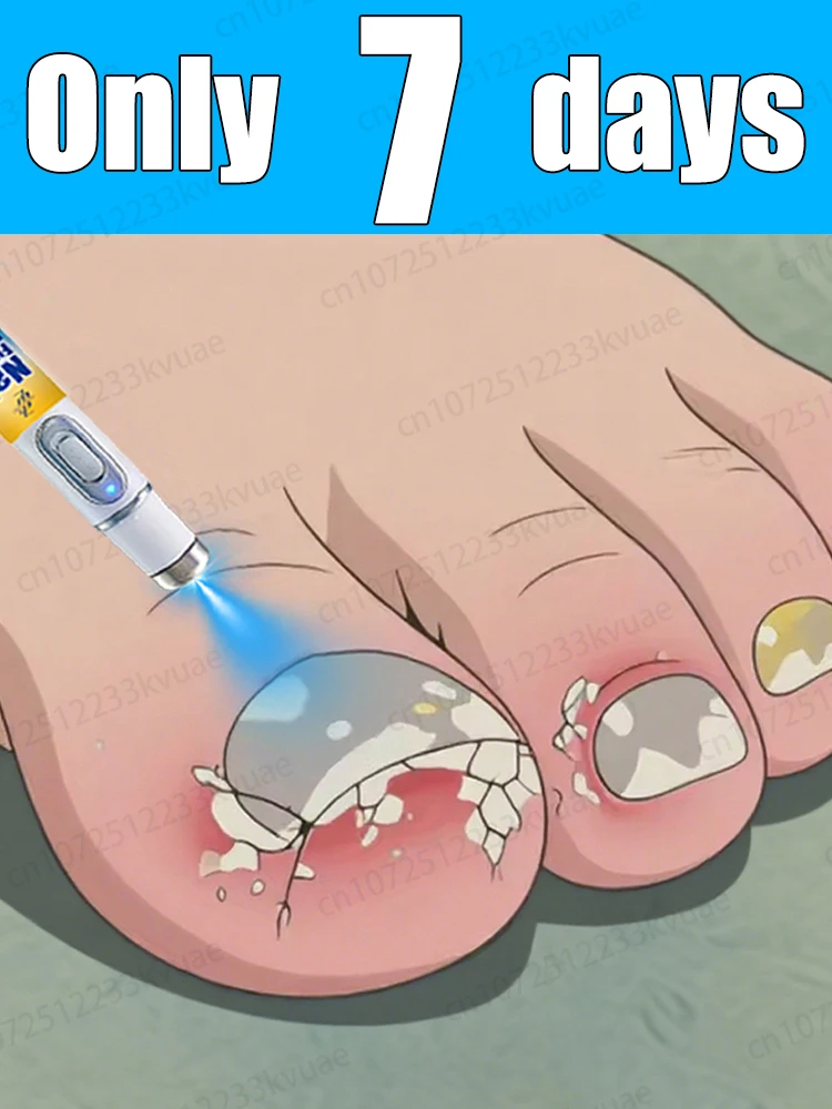 

2025 Hot Sale, Say Goodbye to Onychomycosis, Nail Cleaning