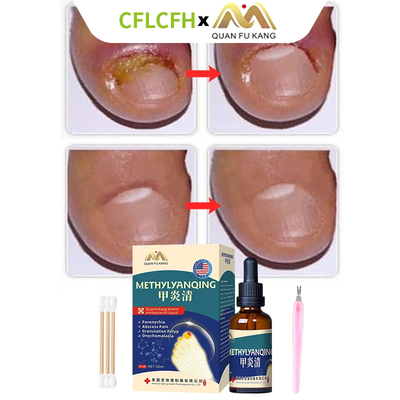 

Paronychia Treatment Liquid Nail Ingrown Correction Tools Onychomycosis Toenail Fungal Care Nail Fungus Cleaner American Formula