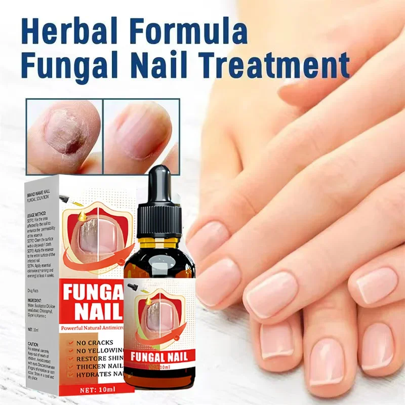 Fungal Nail Treatment Serum Foot Nail Fungus Removal Repair Gel Anti Infection Paronychia Onychomycosis Foot Nails Care Essence