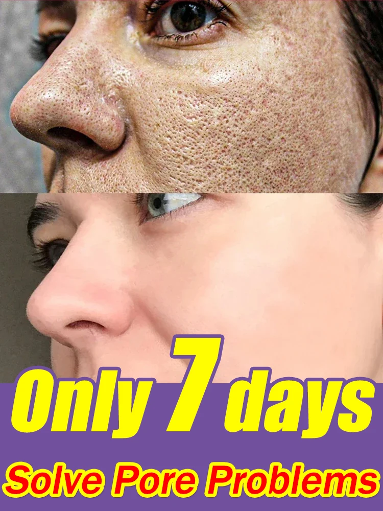 

Solves large pore problem