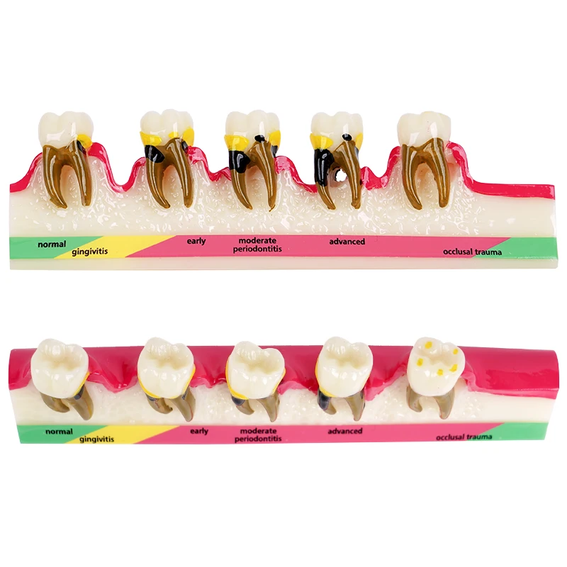 Teeth Periodontal Disease Model Resins Pathological Model 5-Stage Evolutionary for Doctor-Patient Communication