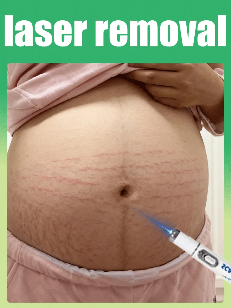 يُستخدم أحدث الليزر الأزرق لعام 2025 لعلامات التمدد وتجديد البشرة دون ترك الندبات