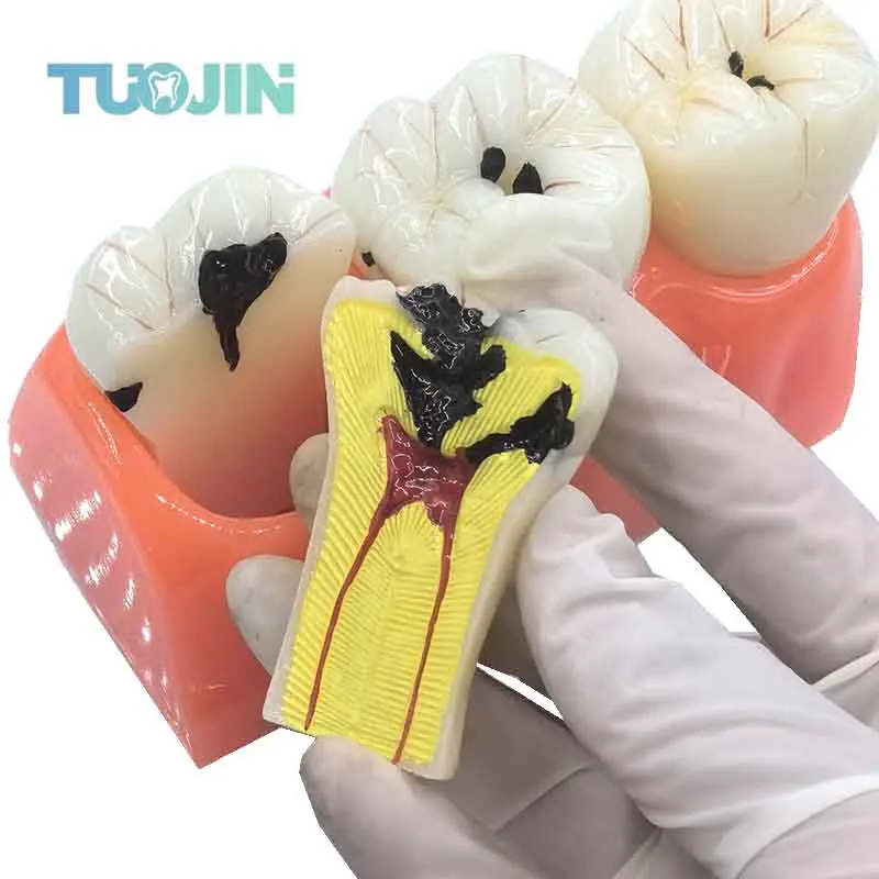 

Dental Decayed Teeth Model Denture Caries Disease Tooth Model Decomposition Decay Tooth Model Dentist Teaching Tools