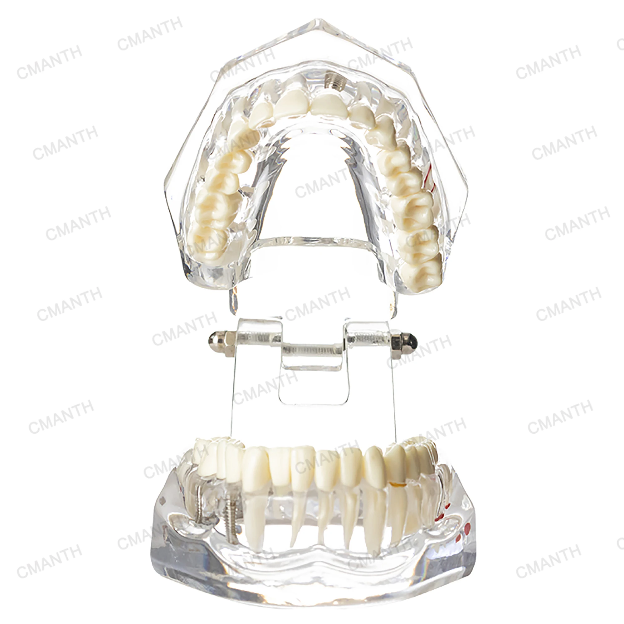 Dental Models Transparent Disease Tooth Model Typodont Implant With Removable Tooth Restoration Bridge Teaching Tooth Model