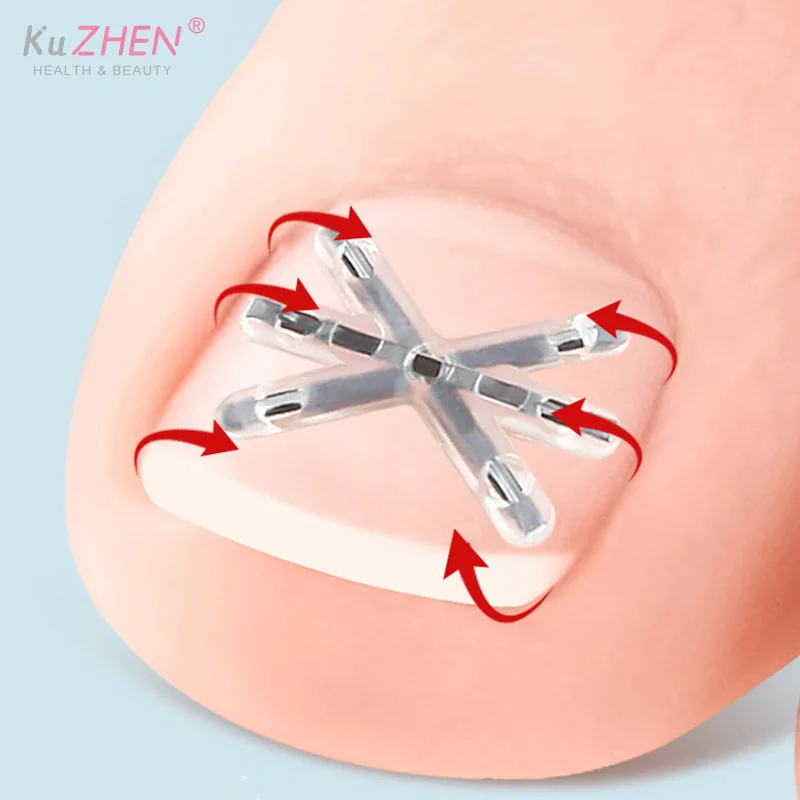 2Pc 13/17MM Ingrown Toenail Correction Tool Ingrown Toenail Treatments Elastic Patch Sticker Toenail Straightening Pedicure Tool