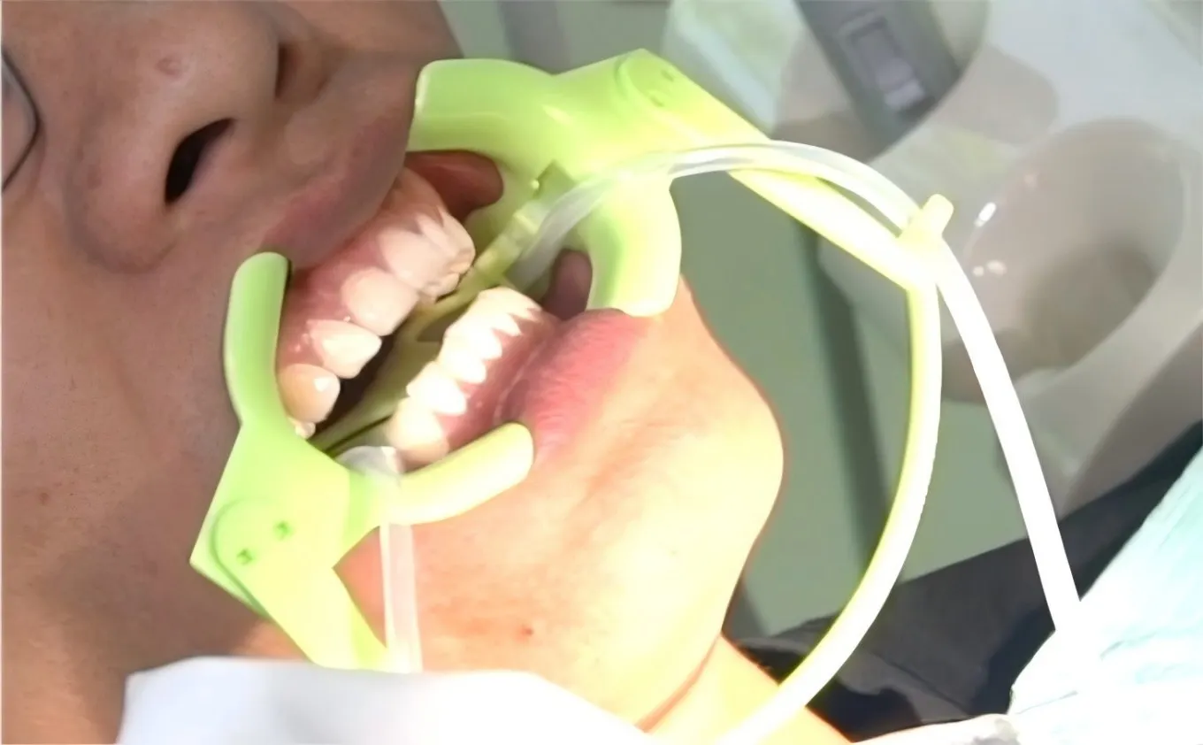 Dental Suction Mouth Opener with Tongue Guard,Intraoral Retractor,Large‑White/Small‑Green,1 Set/Box,Oral Therapy Dentistry Tools view 2