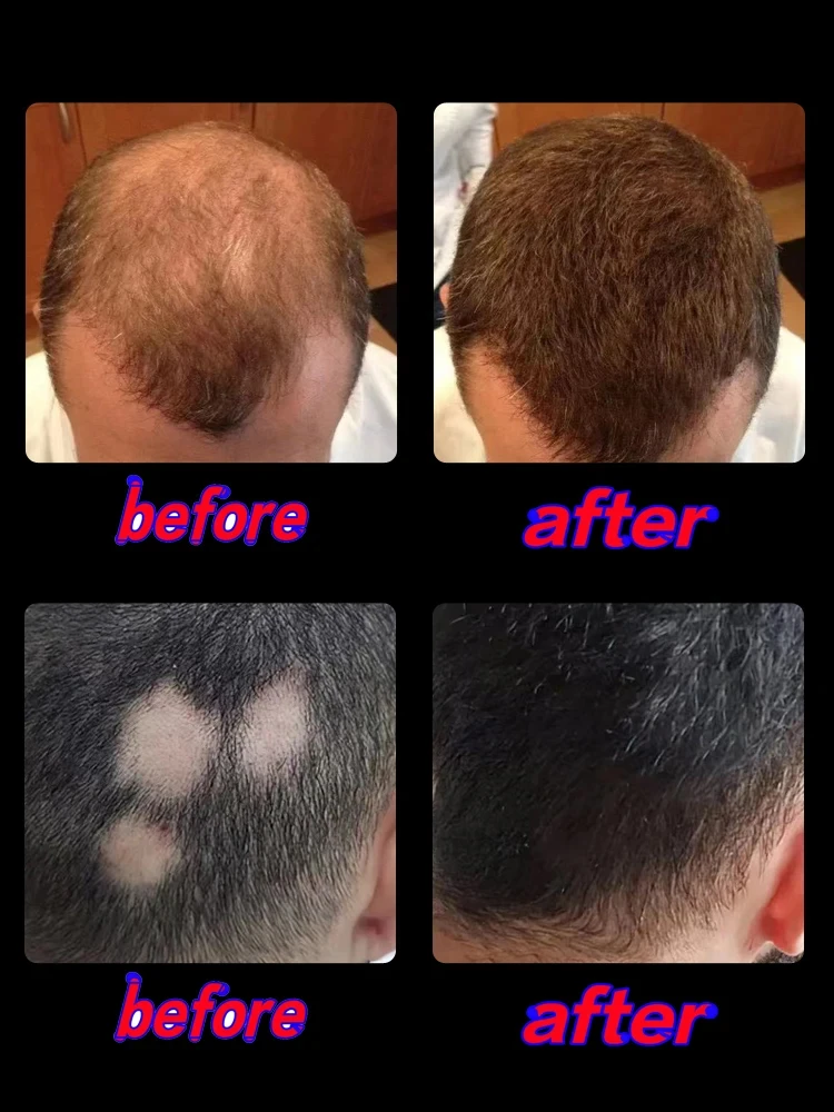 Hair Growth Oil For Men Biotin Fast Baldness Serum